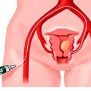 Fibrom uterin - Simptome, Diagnostic, Tratament