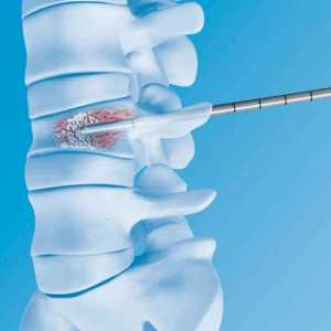 Hemangiomul spinării, ceea ce este și tratamente