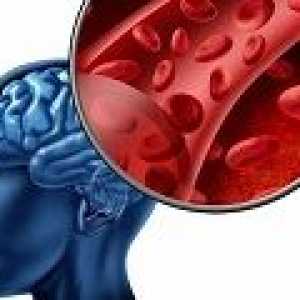 Accident vascular cerebral hemoragic: cauze, simptome, tratament