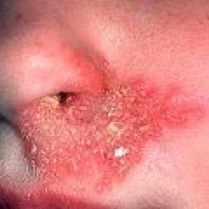 Răni la rece în nas, sub nas: cauze, tratament