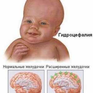 Hidrocefalia creierului