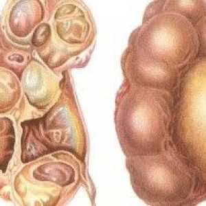 Hidronefroza rinichi - cauze, simptome, diagnostic și tratament