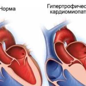 Cardiomiopatia hipertrofica, cauze, simptome, tratament