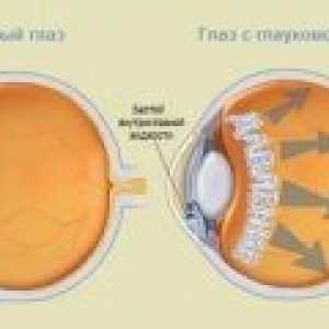 Glaucomul - cauze, simptome, diagnostic