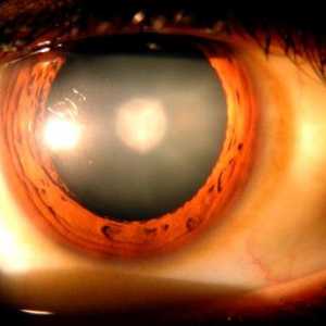 Ocular de presiune: simptome și tratament