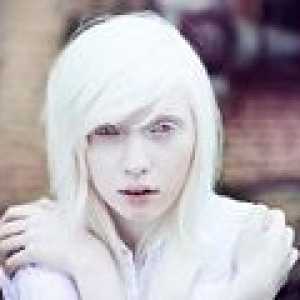 Albinism Oculocutaneous: cauze, simptome, tratament