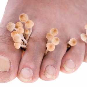 Foot ciuperca: fotografie, simptome, tratament