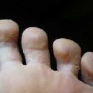 Foot ciuperca - cele mai populare metode de tratament