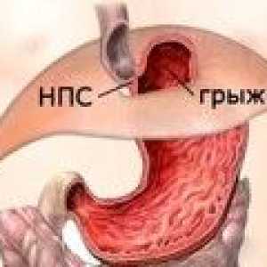 Hernie esofagian: simptome si tratament, dieta