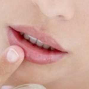 Buzele sparge în mod constant și colțuri ale gurii apar „veți alege“