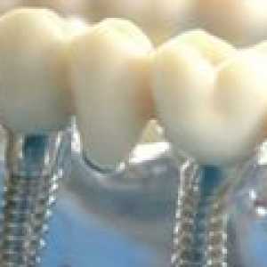 Implanturile dentare: fapte cheie