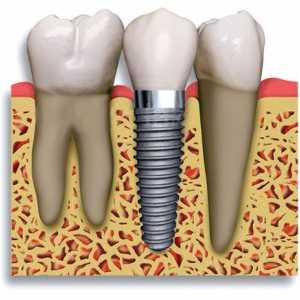 Implanturile dentare: contraindicații și posibile complicații