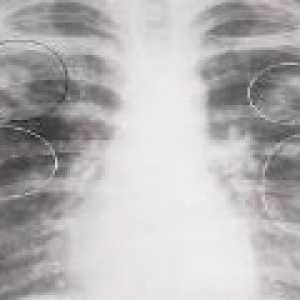 Tuberculoză pulmonară infiltrativă: simptome, faza, tratament