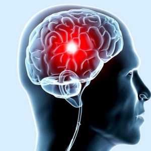 Simptomele accident vascular cerebral sunt primele semne ale
