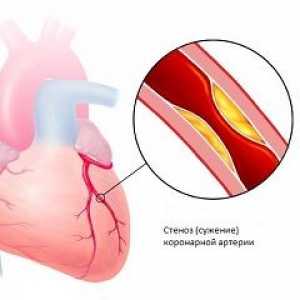 Boala arterelor coronare