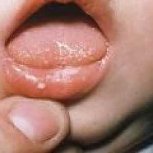 Ulcerații la nivelul gurii: cauze. tratament