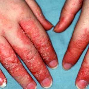 Eczeme pe mâini: vindecarea, medicamente, comentarii