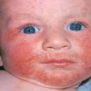 Eczema copilului: simptome, tratament