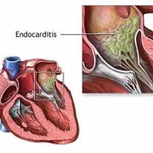 Endocardită