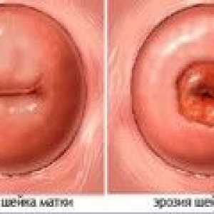 Eroziune de col uterin si sarcina