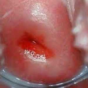 Simptome de eroziune de col uterin