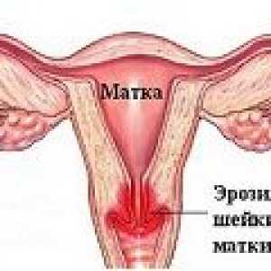 Eroziune cervicală în timpul sarcinii, cauze, tratament