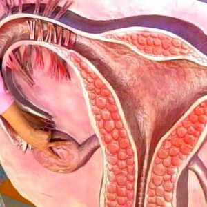 Cum de a trata sindromul de ovar polichistic