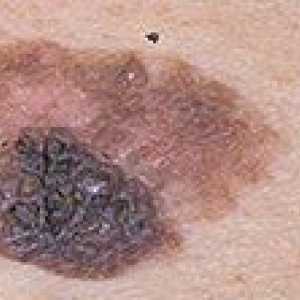 Cum de a determina prezența melanomului și vindecarea acesteia