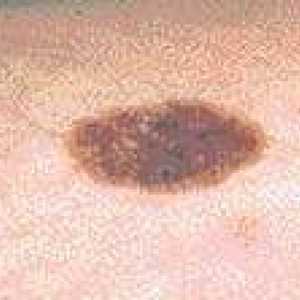 Cum este melanomul și sistemul Breslow Clark