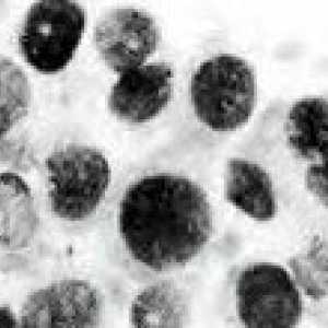 Cum de a recunoaște și de a trata melanomul epitelioida