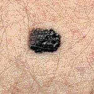 Cum recunoști un melanom: simptome si metode de diagnostic