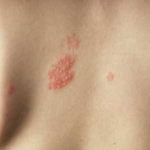 Cum de a recunoaște un herpes zoster la oameni: boala si tratamentul acesteia în fotografii