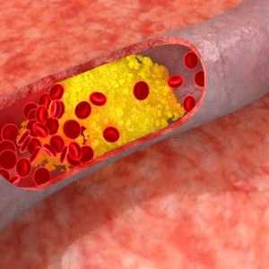Cum de a reduce nivelul colesterolului din sânge (colesterol rata pentru femei și bărbați)