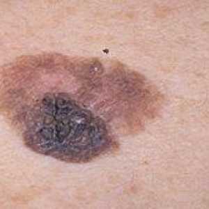 Ce cauze contribuie la apariția melanomului