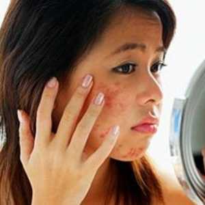 Ce modalitate de a reduce cicatrici acnee