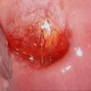 Col uterin chistul: cauze si tratament