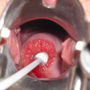 De col uterin chisturi: simptome și tratament