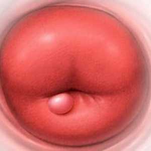 Chist de col uterin