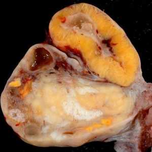 Chist a corpului galben ovar: Simptome si tratament