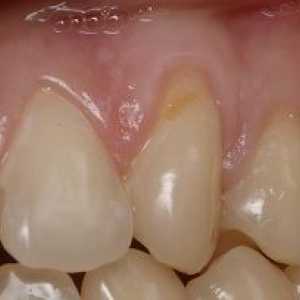 Dinții defect în formă de pană