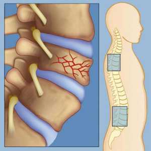 Fractura de compresie a coloanei vertebrale lombare: varietatea și tratament