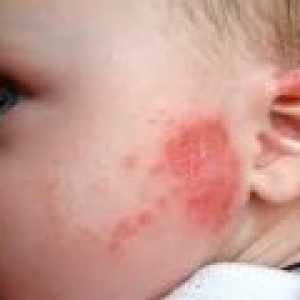 Pete roșii pe piele a unui copil - cauze, tratament