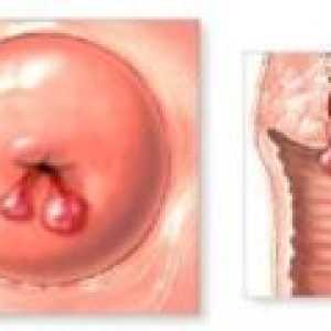 Tratamentul displazie de col uterin