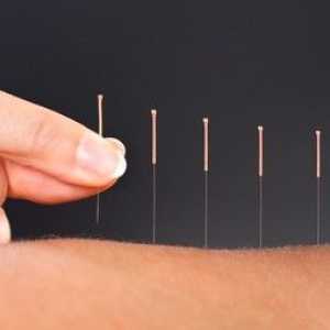 Acupunctura: Adevaruri si mituri