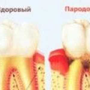 Tratamentul bolii parodontale la domiciliu