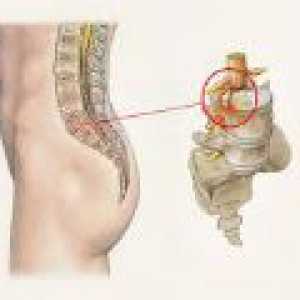 Tratamentul protruziei a coloanei vertebrale lombare