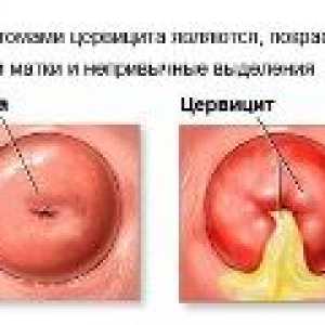 Tratamentul de inflamație de col uterin