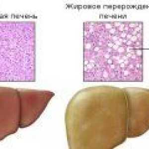 Tratamentul steatozei hepatice
