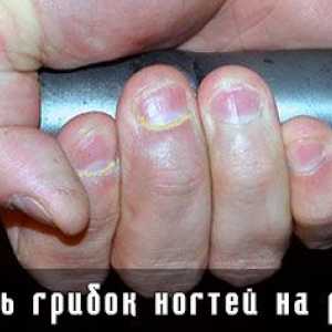 Fungus unghiilor trata pe mâini