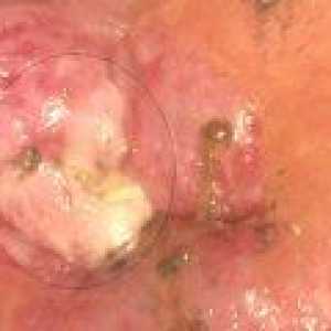 Cervicale leucoplazie: Simptome, cauze si tratament